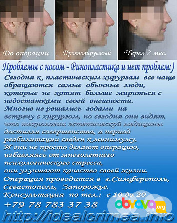 Пластические операции носа, груди, ушей, лица, коррекция фигуры Симферополь - изображение 1