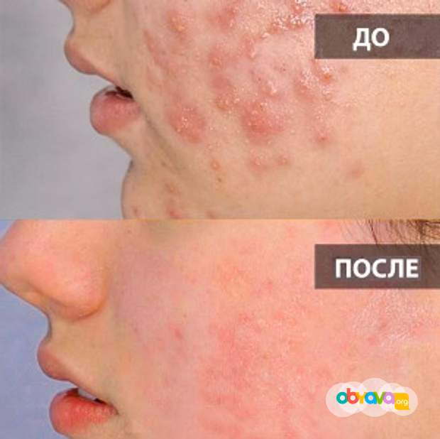 Катушки Мишина с генератором